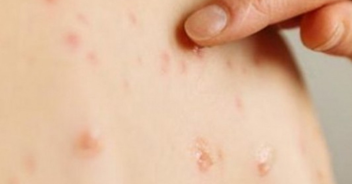 ХӨСҮТ: Улаанбурхан өвчний батлагдсан тохиолдол 10 нэмэгджээ