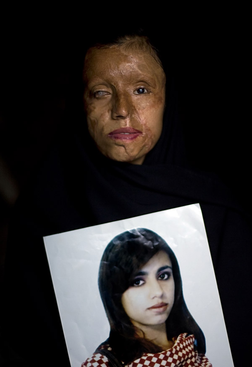 Хүчил цацуулсан Пакистан охидын "Сэтгэл шимшрэм" түүхүүд /+16 Фото/ 
