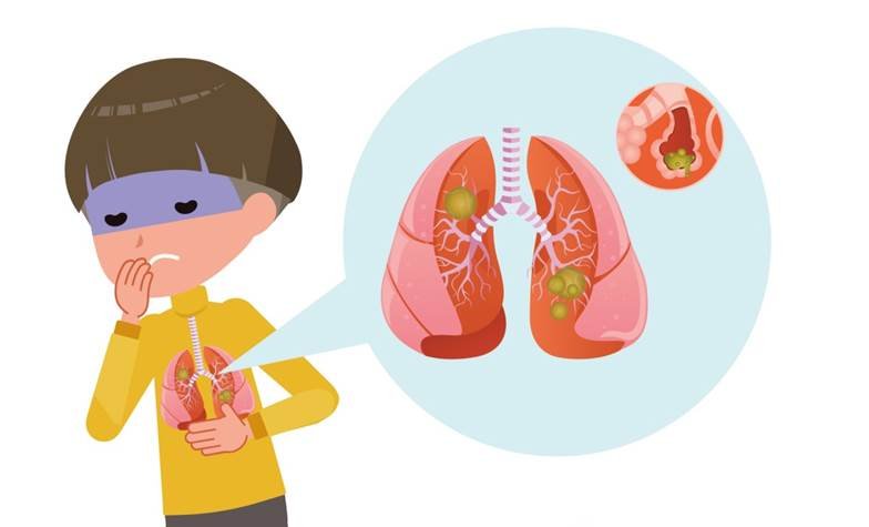БНХАУ-д дэгдээд буй "Микоплазм шалтгаант уушгины хатгааны үед илрэх шинж тэмдэг"