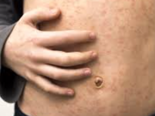 Улаанбурхан өвдсөн биеийн байдал нь хүнд ГУРВАН хүн эмчлүүлж байна